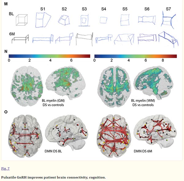 Pulsatile GnRH inproves atient brain connectivity cognition.