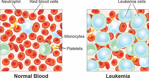 正常血液和白血病的成分示意图